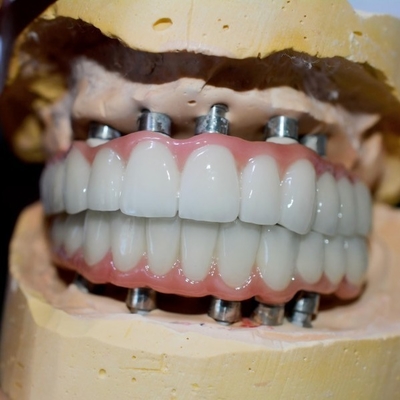 El viaje a una sonrisa sana nuestro proceso de la corona del implante dental