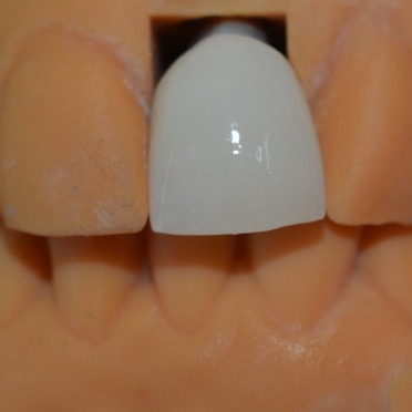 La fuerza detrás de nuestro éxito nuestros técnicos de la corona del implante dental