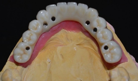 Elevando estándares nuestra garantía de calidad de la corona del implante dental