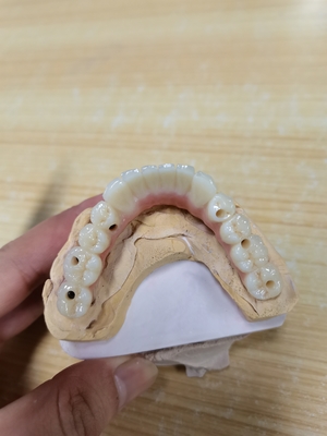 Elevando estándares nuestra garantía de calidad de la corona del implante dental
