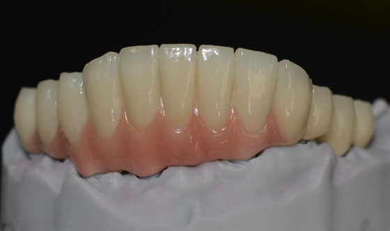 Abrazando adelantos tecnológicos el futuro de las coronas del implante dental