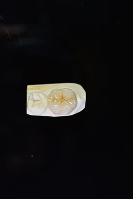 Longevidad y durabilidad una inversión del curso de la vida con nuestras coronas dentales de cerámica