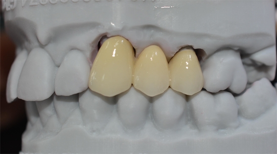 Longevidad y durabilidad una inversión del curso de la vida con nuestras coronas dentales de cerámica