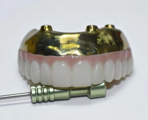 Puente completo de zirconia con soporte de barra de titanio