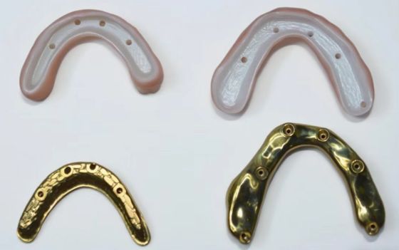 Puente completo de zirconia con soporte de barra de titanio
