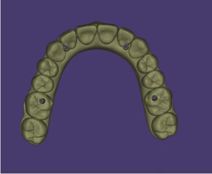 Diseño AOX Servicio profesional de diseño de puentes de implantes de arcada completa