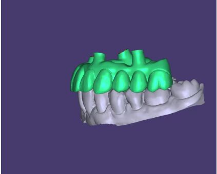 Diseño AOX Servicio profesional de diseño de puentes de implantes de arcada completa