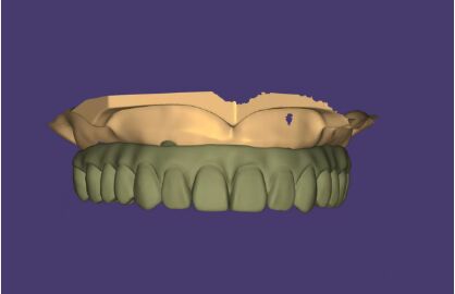 Diseño AOX Servicio profesional de diseño de puentes de implantes de arcada completa