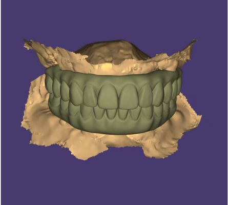 Diseño AOX Servicio profesional de diseño de puentes de implantes de arcada completa
