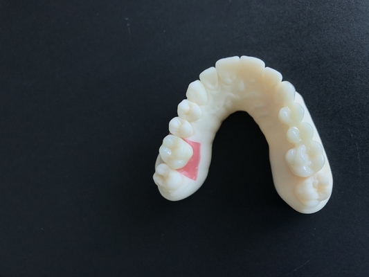 Escaneo oral digital PFM Coronas dentales Puente Demandas de implantología
