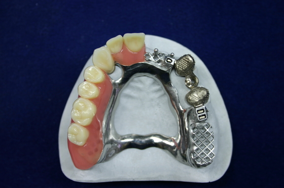Hermosa apariencia Apego de precisión Dentadura Apego de implantes