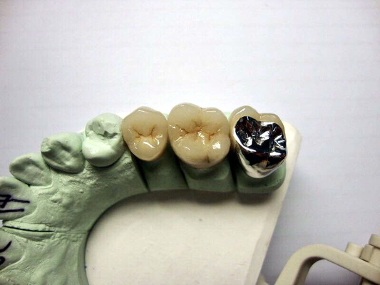 Alta porcelana de la corona de Biocompatibility PFM fundida para la restauración de los dientes traseros