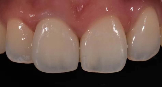 Alta porcelana de la corona de Biocompatibility PFM fundida para la restauración de los dientes traseros