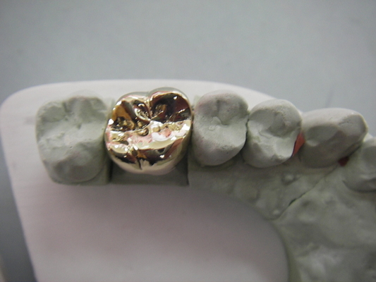 Material biológico de High Tech del metal PFM del puente dental lleno de la corona