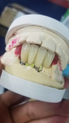 La corona biocompatible superficial lisa del diente de la circona fácil mantiene
