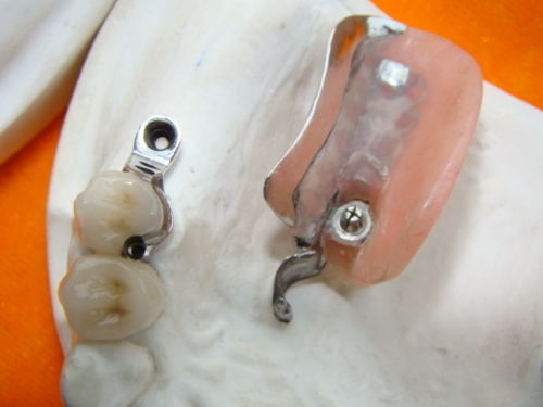 La dentadura duradera del accesorio de la precisión del laboratorio dental mancha resistente