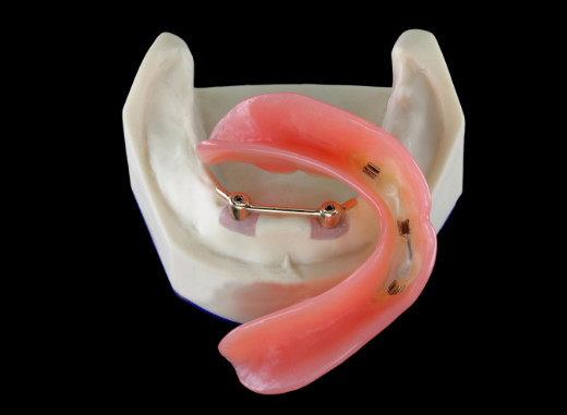 Implante dental de la seguridad del laboratorio de la alta dentadura inter biológica de la miscibilidad