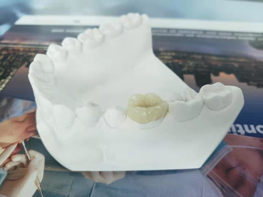 Sobrepuesto dental totalmente de cerámica durable del embutido de la chapa de la corona del FDA similar