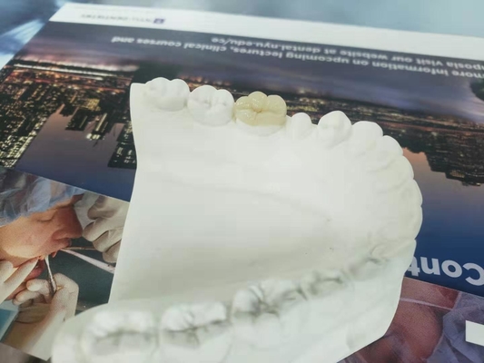 Sobrepuesto dental totalmente de cerámica durable del embutido de la chapa de la corona del FDA similar
