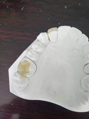 Sobrepuesto dental totalmente de cerámica durable del embutido de la chapa de la corona del FDA similar