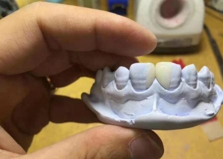 Materiales dentales desprendibles de la salud de la corona de la resina eficiente PFM