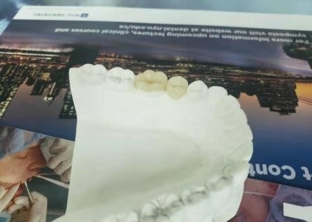 Corona flexible durable IPS dental E Max Press Inlay Onlay del puente de PFM