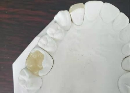Corona flexible durable IPS dental E Max Press Inlay Onlay del puente de PFM