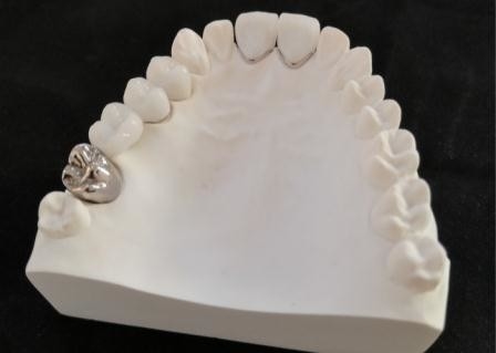 Resistencia a la corrosión completa modificada para requisitos particulares del metal de la corona dental de la porcelana de PFM