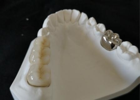 Corona dental de pulido alto Intermiscibility biológico de la porcelana del OEM