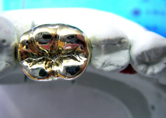 Alto bastidor fácil dental semi precioso del puente PFM de la corona de la estabilidad