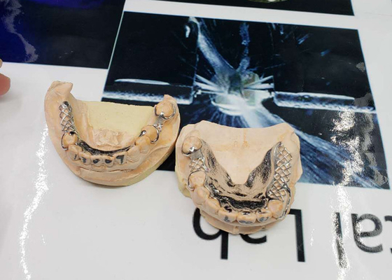 La alta exactitud CAD-CAM fijó diseño desprendible de la numeración del puente