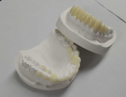 Alta durabilidad CAD CAM Impresión 3D Coronas temporales Resina duradera