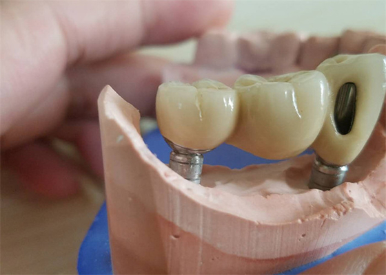 Corona dental de la circona de la leva del cad con el contrafuerte de la circona de la base del titanio