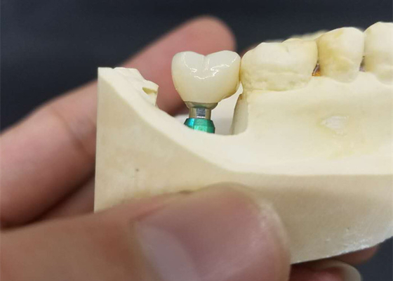 Color ultra difícilmente al OEM de la estabilidad que la corona del implante dental fácil mantiene