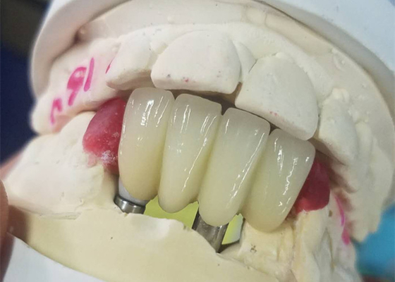Base fuerte del Ti que muele el puente apoyado diente de las coronas del implante dental