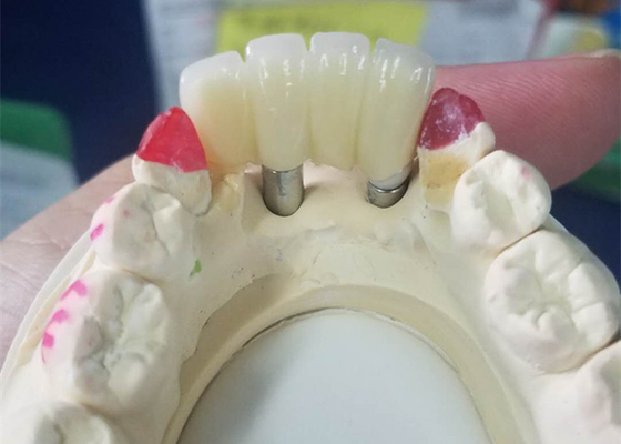 Base fuerte del Ti que muele el puente apoyado diente de las coronas del implante dental