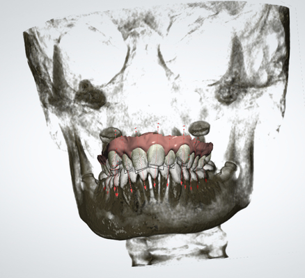Ampliador palatal rápido del OEM del dispositivo ortodóntico desprendible exacto