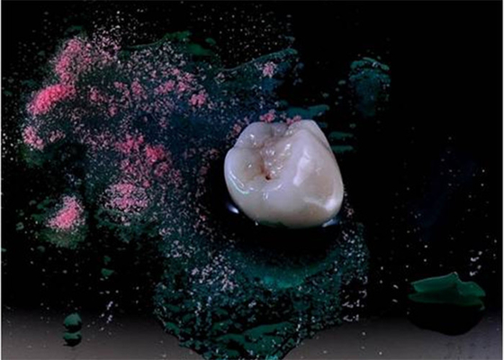 Chapee ultra difícilmente las dentaduras de pulido del implante de la corona totalmente de cerámica dentales