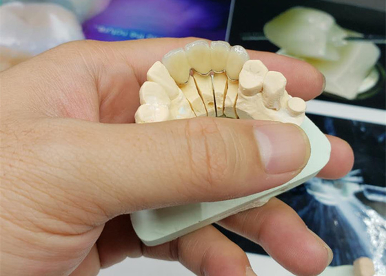 Corona resistente a la corrosión de la porcelana del OEM de la seguridad toda la mirada natural de cerámica