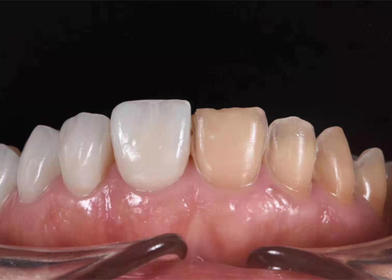 Corona dental de cerámica que blanquea de 0.3M M para substituir los dientes malsanos