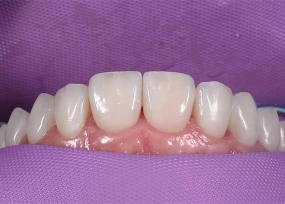 Corona dental de cerámica que blanquea de 0.3M M para substituir los dientes malsanos