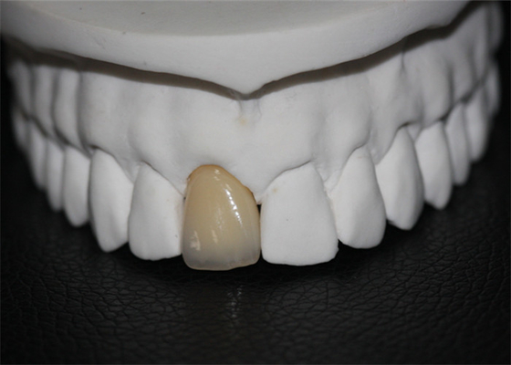 Corona dental de la porcelana del Cr del Co