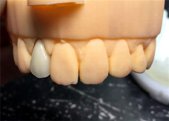 Puente dental buen Biocompatibility de la corona de la seguridad PFM de Chromecast