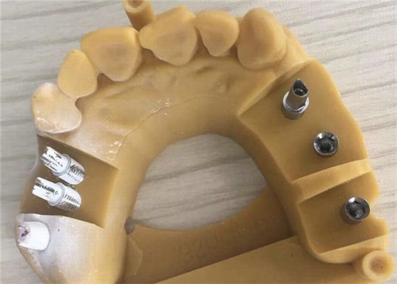 Corona dental 3D de Digitaces Biocompatibility PFM que imprime las coronas temporales
