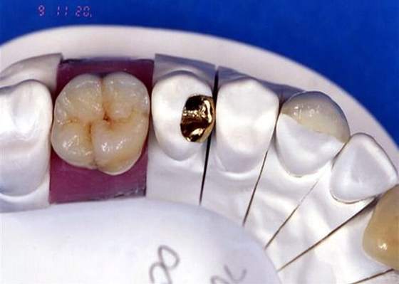Corona dental de la porcelana de PFM