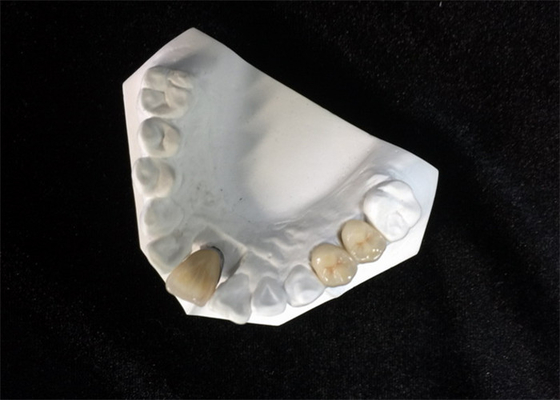 El diente natural de la alta corona dental de cerámica de la estabilidad PFM mancha resistente