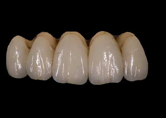 Fácil mantenga la estabilidad del color dental de la corona de la porcelana ortodóntica de PFM