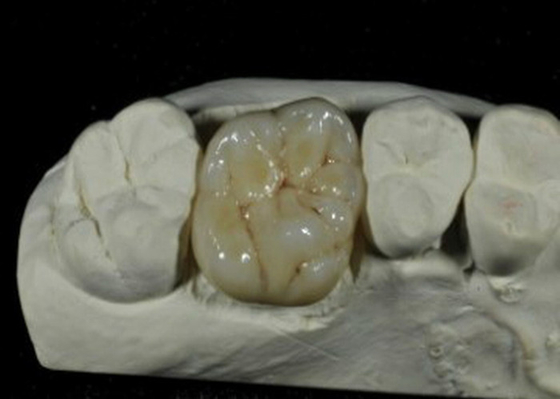 Corona dental de la porcelana flexible del CE ISO para la restauración de los dientes traseros
