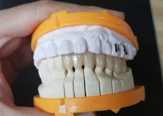 Coronas de cerámica de encargo del tamaño PFM para los dientes posteriores y anteriores