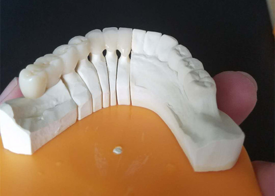 Coronas de cerámica de encargo del tamaño PFM para los dientes posteriores y anteriores